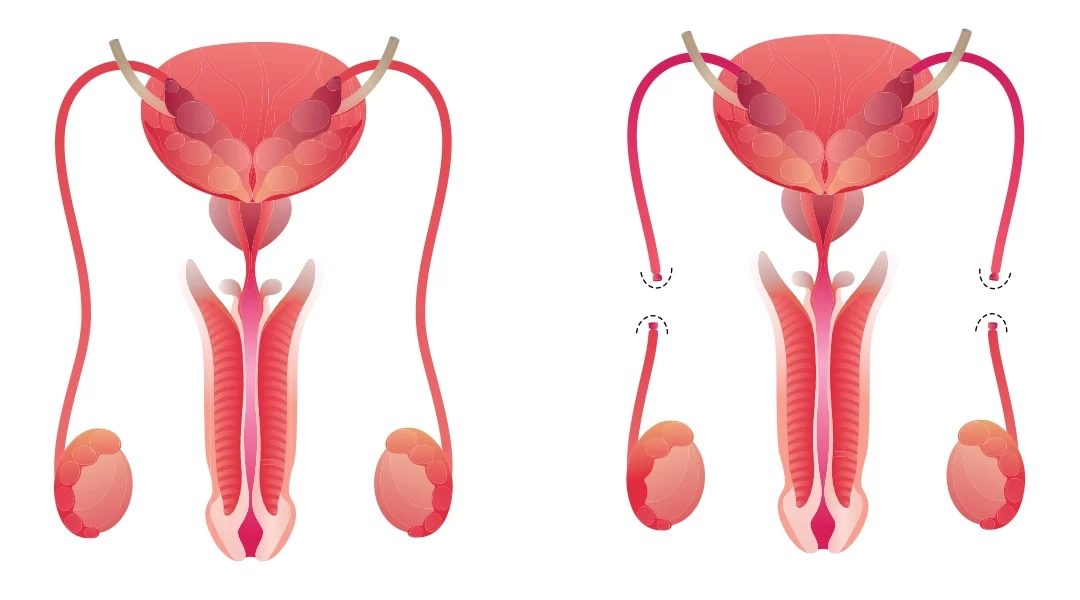 Wazektomia