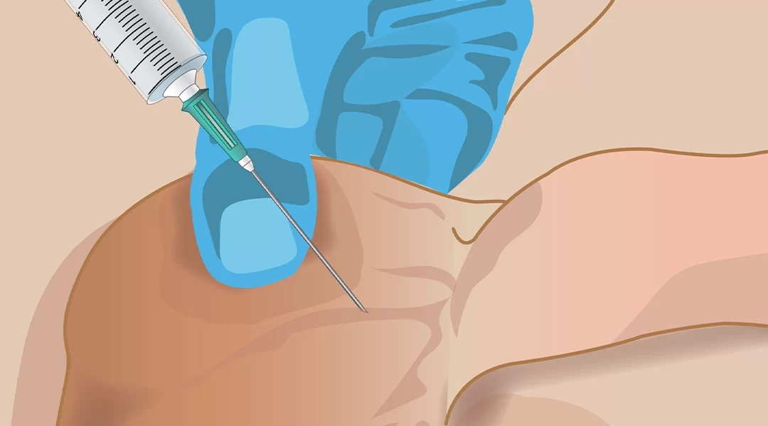 OSTRZYKNIĘCIE MOSZNY TOKSYNĄ BOTULINOWĄ – SCROTOX