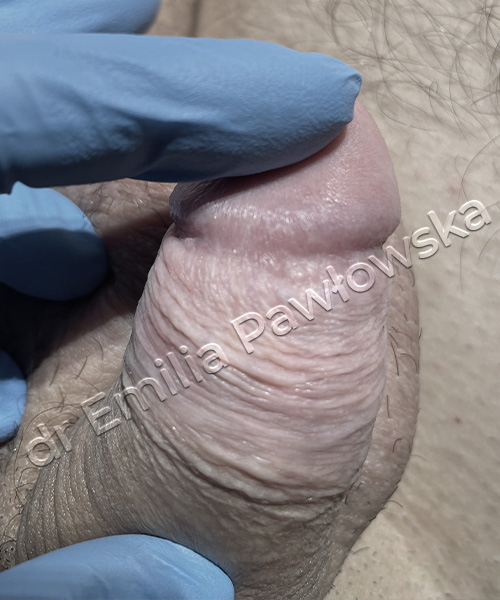 Grudki_Perliste_Pracia_Po_3_tyg_1 Grudki perliste prącia po operacji